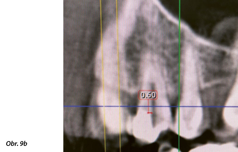 Obr. 9: b) CBCT zubu 24 – je viditelná pozice zubní dřeně 0,6 mm od výplně.