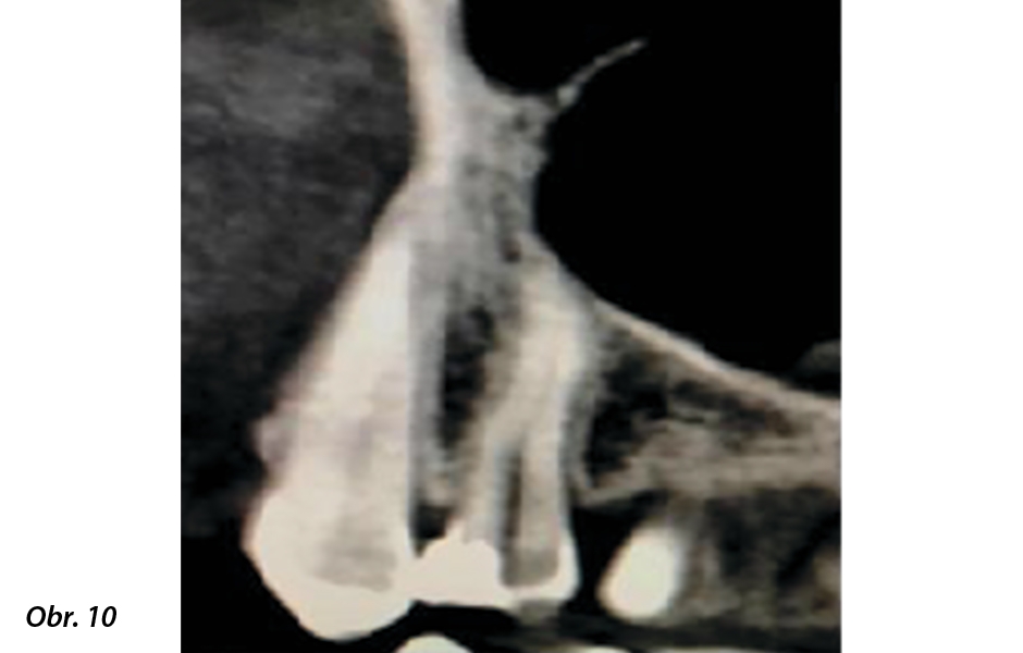Obr. 10: CBCT zubu 24 čtyři roky po biologické léčbě. Zubní dřeň, periodoncium a integrita maxilárního sinu zůstaly zachovány.