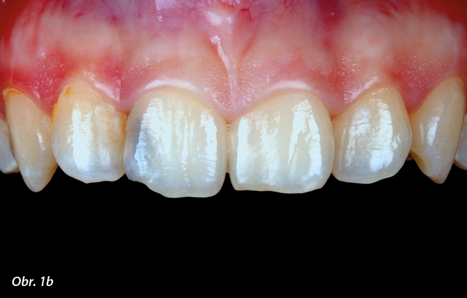 Fotografie s uměle navýšenou sytostí může pomoci posoudit barevný tón dentinu.