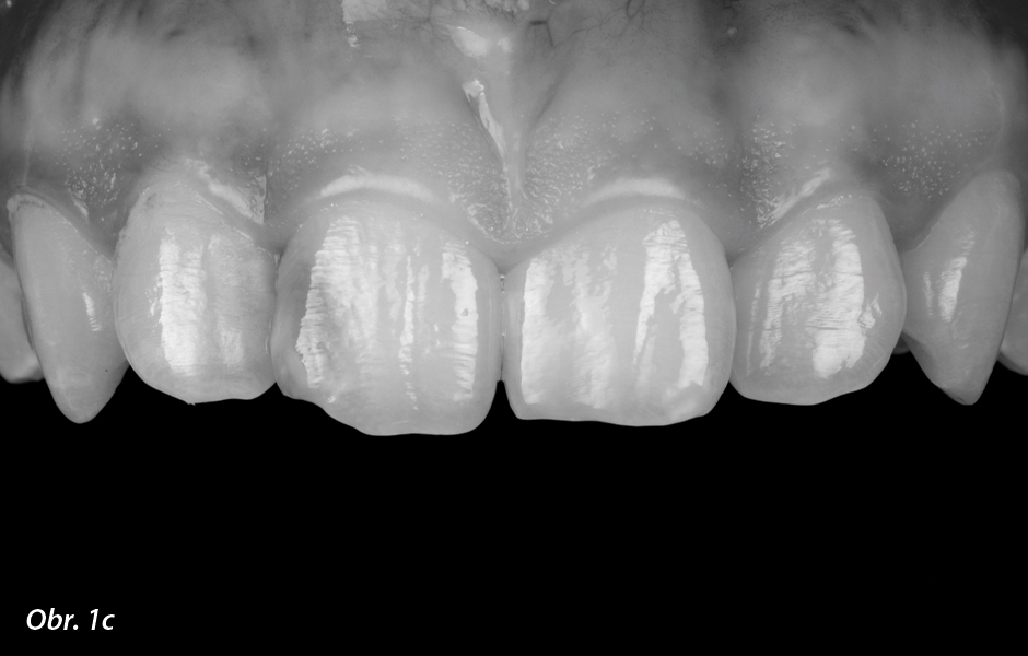 Černobílá fotografie je užitečná k určení světlosti skloviny. Určování odstínu by se mělo provádět před bondováním, protože nasazení kofferdamu vede k dehydrataci zubů a změně jejich přirozeného odstínu.
