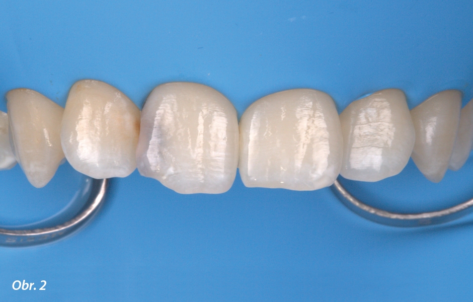 Situace před ošetřením po nasazení kofferdamu – izolace se důrazně doporučuje pro dosažení účinné a dlouhodobé adheze na strukturu zubu.