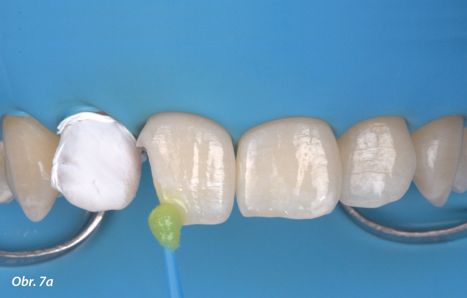 Nanášení G-Premio BOND na strukturu zubu pomocí mikroštětečku až do úplného pokrytí všech vazebných povrchů. Vazebný prostředek se poté nechá působit po dobu 10 sekund. Kontrola nad nanášením je velice pohodlná díky nažloutlé barvě vazebného prostředku.