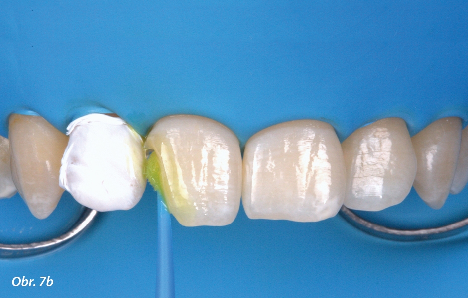 Nanášení G-Premio BOND na strukturu zubu pomocí mikroštětečku až do úplného pokrytí všech vazebných povrchů. Vazebný prostředek se poté nechá působit po dobu 10 sekund. Kontrola nad nanášením je velice pohodlná díky nažloutlé barvě vazebného prostředku.