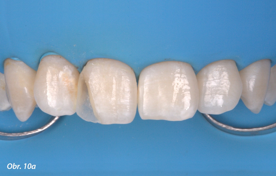 Nanášení kompozitní pryskyřice (GC G-ænial JE na palatinální straně, G-ænial AO2 opakní dentin, G-ænial A2 dentin a GC Kalore WT sklovina). Díky velmi tenké vrstvě G-Premio BOND není vazebná vrstva viditelná.