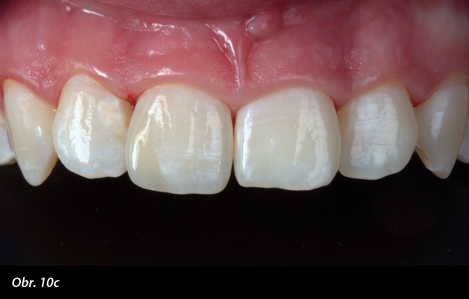 Nanášení kompozitní pryskyřice (GC G-ænial JE na palatinální straně, G-ænial AO2 opakní dentin, G-ænial A2 dentin a GC Kalore WT sklovina). Díky velmi tenké vrstvě G-Premio BOND není vazebná vrstva viditelná.