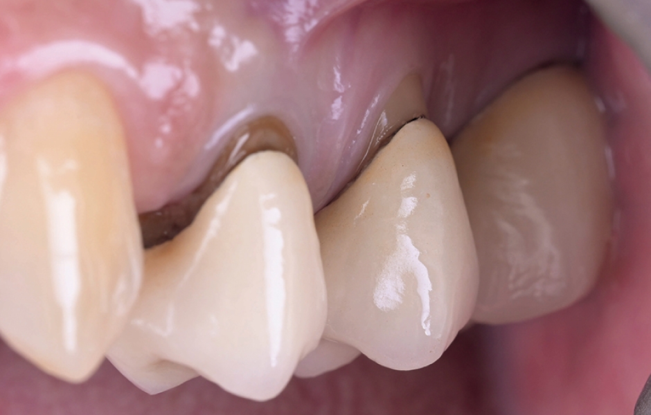 Obr. 1: Výchozí klinická situace s patrným nevyhovujícím marginálním uzávěrem stávajících korunek na zubech 24 a 25.