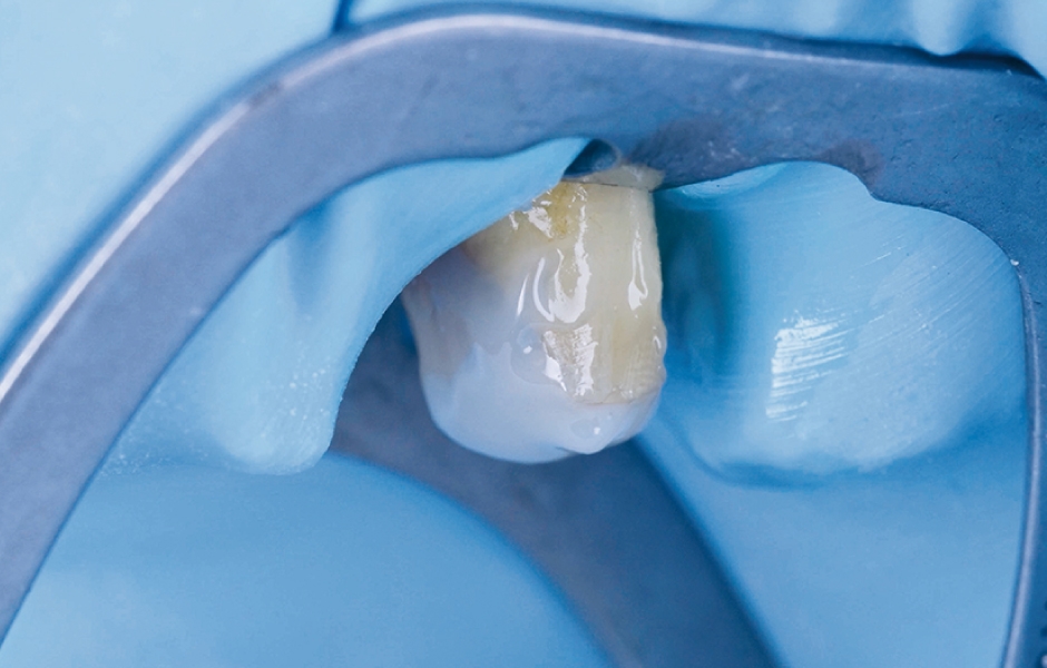 Obr. 3: Dostavba korunkové části zubu 25.