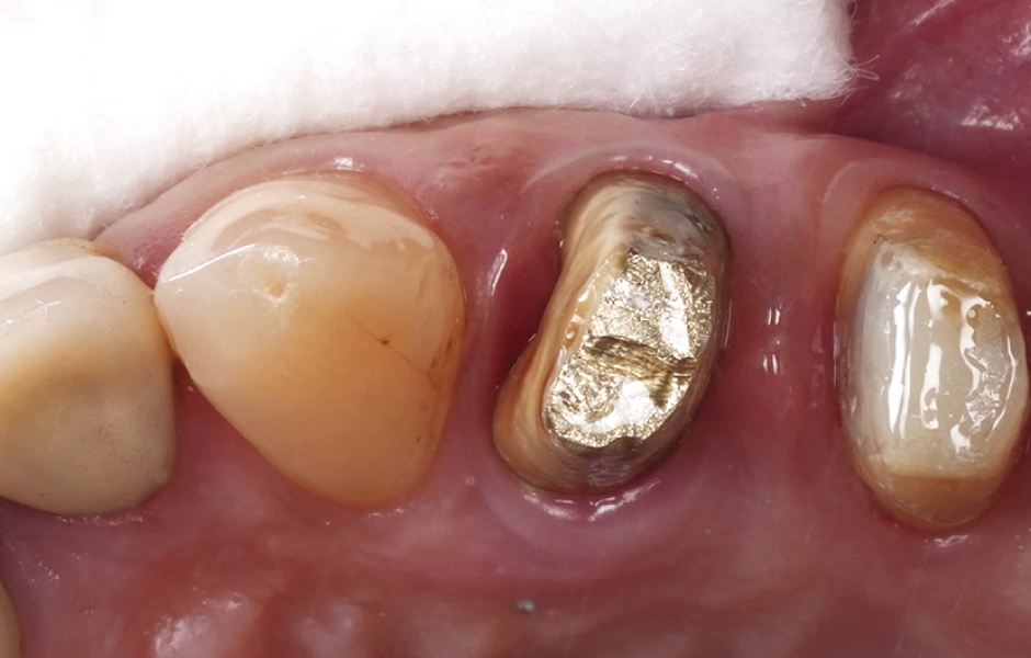 Obr. 9: Stav po oplachu přípravku RetraXil – prostředí bez krevních stop a reziduí materiálu.