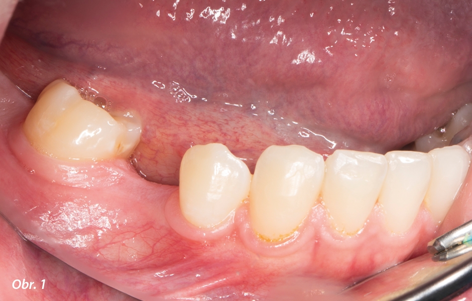 Dolní zuby pacientky před ošetřením.