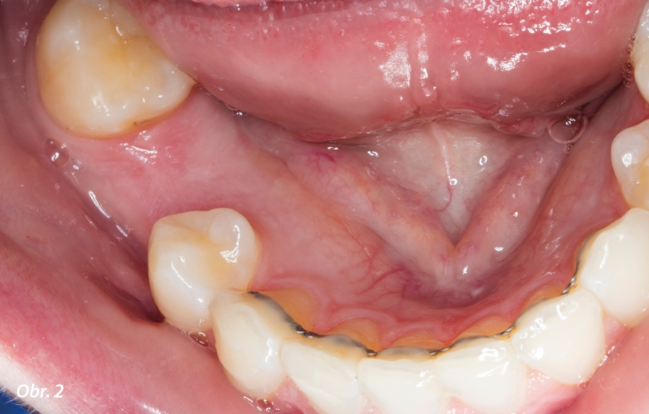 Dolní zuby pacientky před ošetřením.