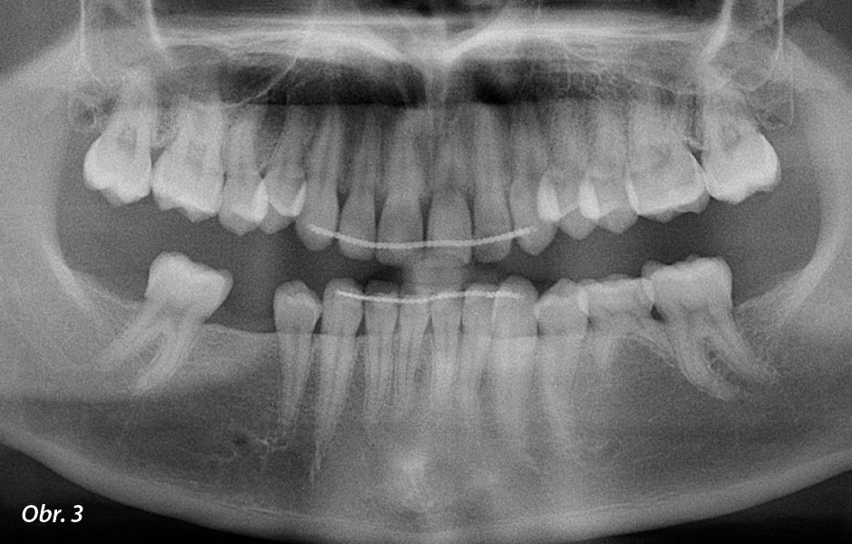 Panoramatický RTG snímek pořízený pomocí rentgenu Planmeca Promax 2D ukázal chybějící stálé zuby.