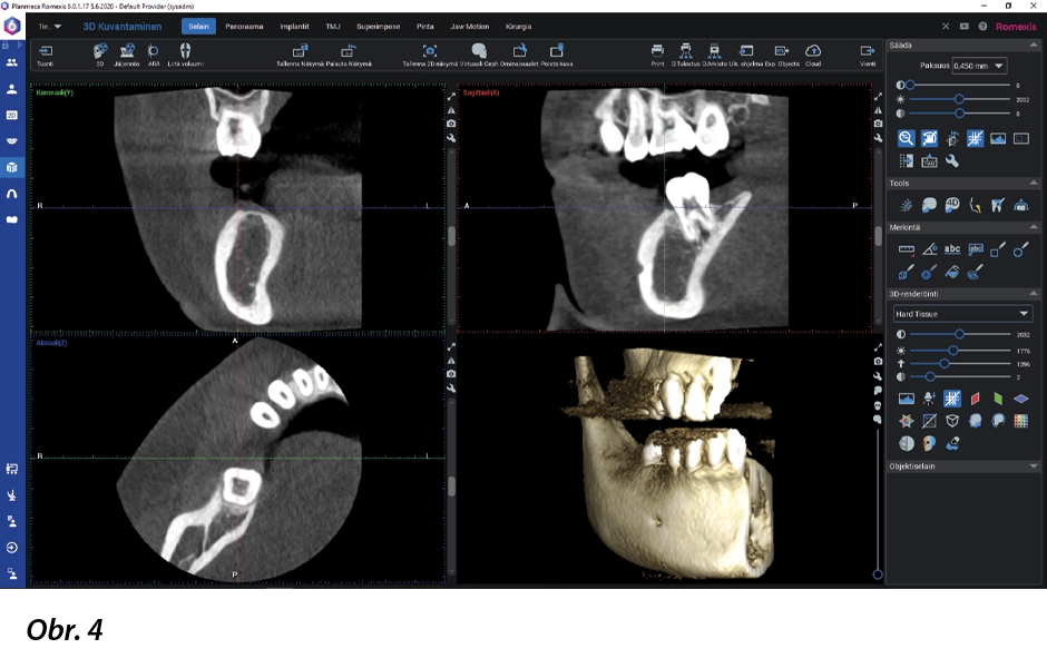 3D snímek postižené oblasti byl pořízen pomocí rentgenu Planmeca Viso G7.