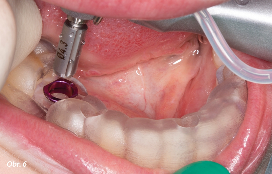 Chirurgická fáze zavádění implantátu byla provedena pomocí chirurgické šablony vytištěné na 3D tiskárně.