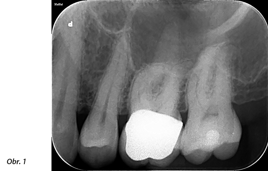 Endodontické ošetření – případová studie