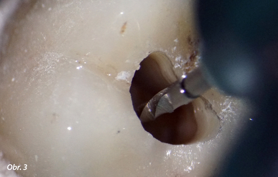 Endodontické ošetření – případová studie