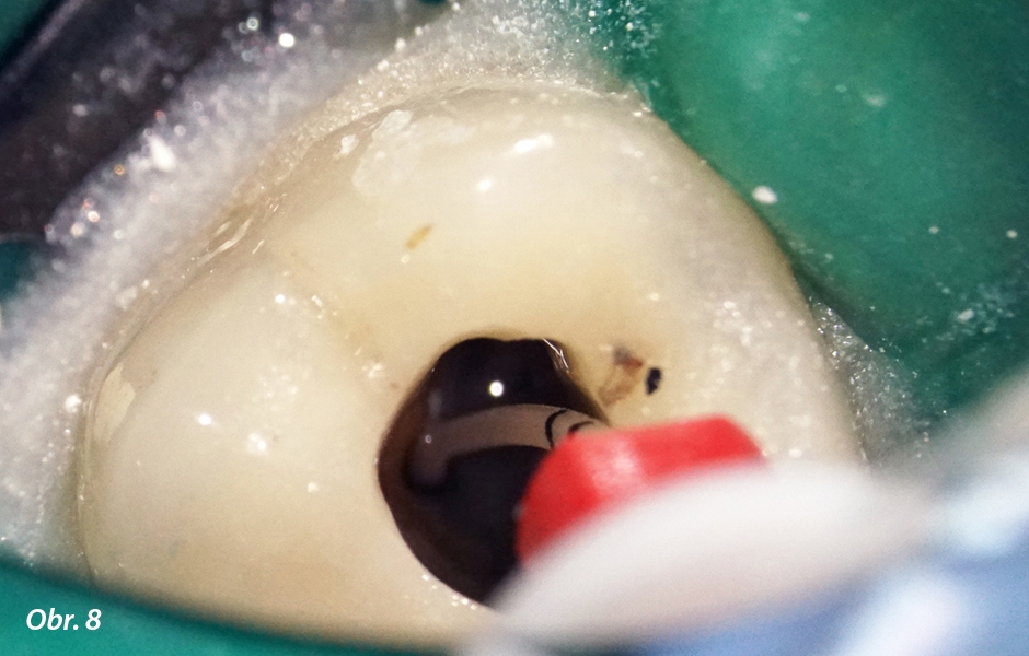 Endodontické ošetření – případová studie