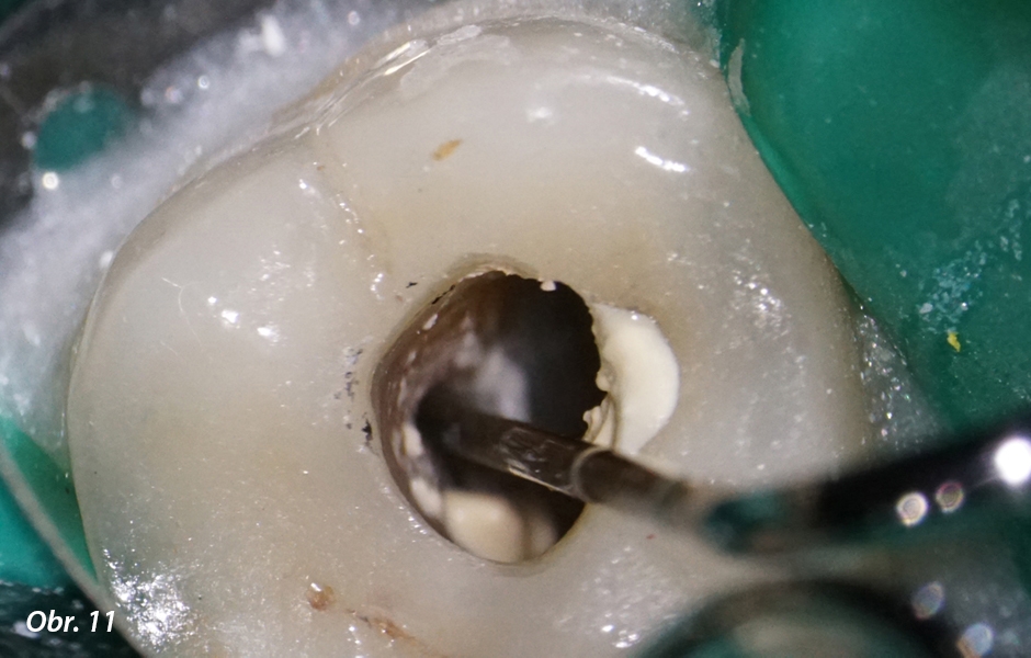 Endodontické ošetření – případová studie