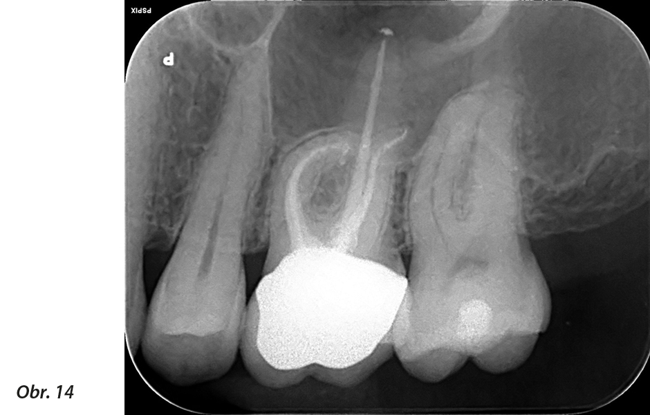 Endodontické ošetření – případová studie