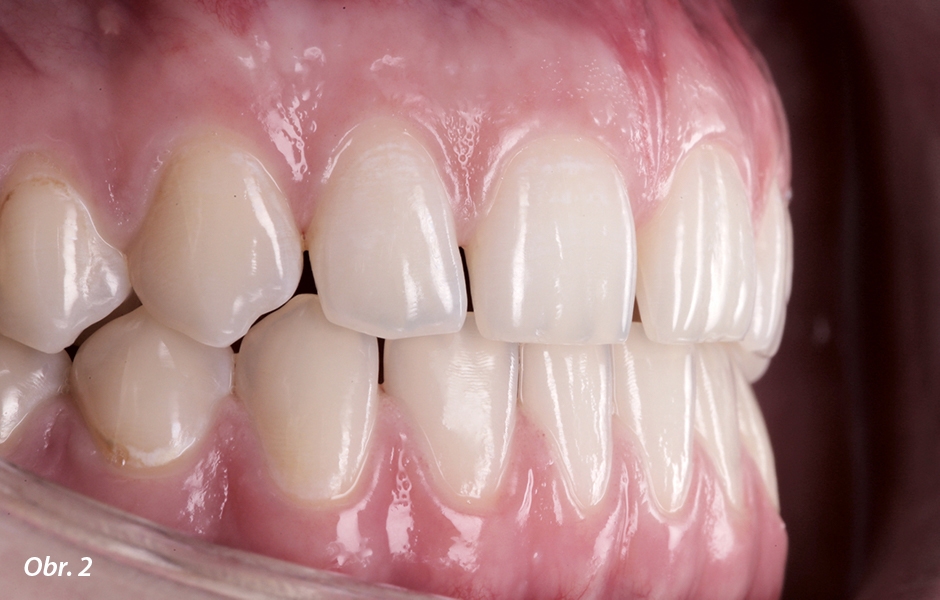 Toto je přirozená struktura zubů, kterou jsme chtěli napodobit u definitivních náhrad