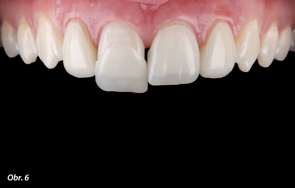 Zkouška vyfrézovaného mock-upu fazet v ústech