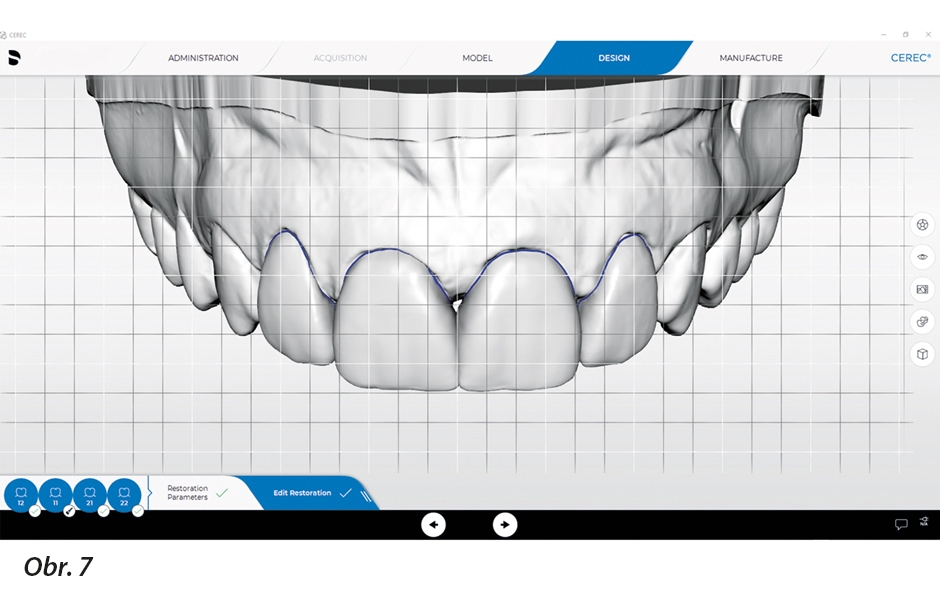 Export dat do softwaru CEREC SW 5.1.1 a konečný design fazet