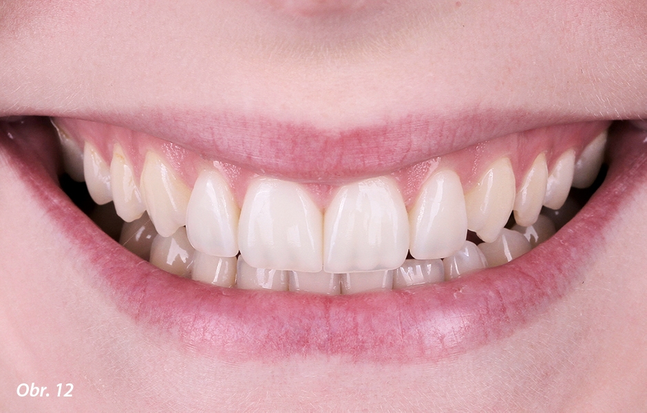 Detailní snímek povrchu fazet, který zachycuje dobré přizpůsobení přirozenému povrchu zubů
