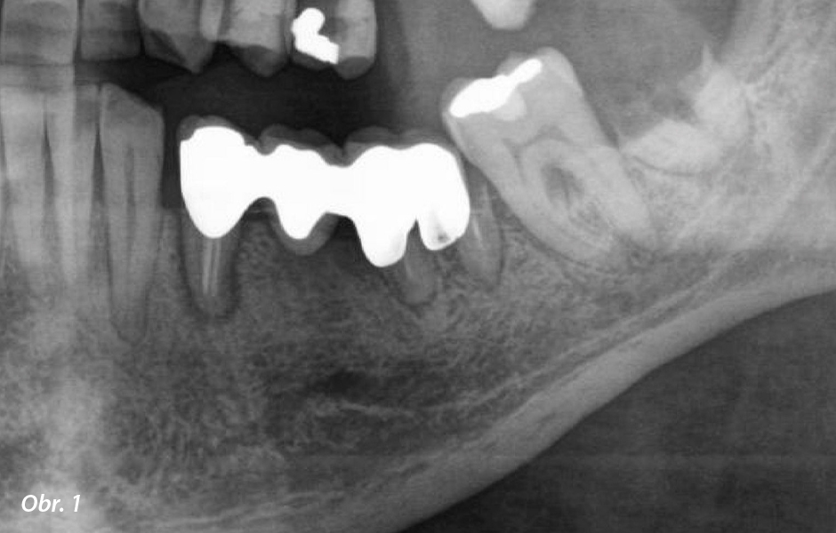 Rehabilitace částečně bezzubého fobického pacienta pomocí kónických implantátů, augmentace kosti a keramického vhojovacího abutmentu