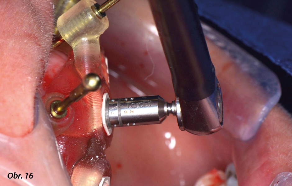 Celková rekonstrukce chrupu u bezzubého pacienta pomocí implantátů Straumann® BLX a konceptu Pro Arch navigovaná chirurgie