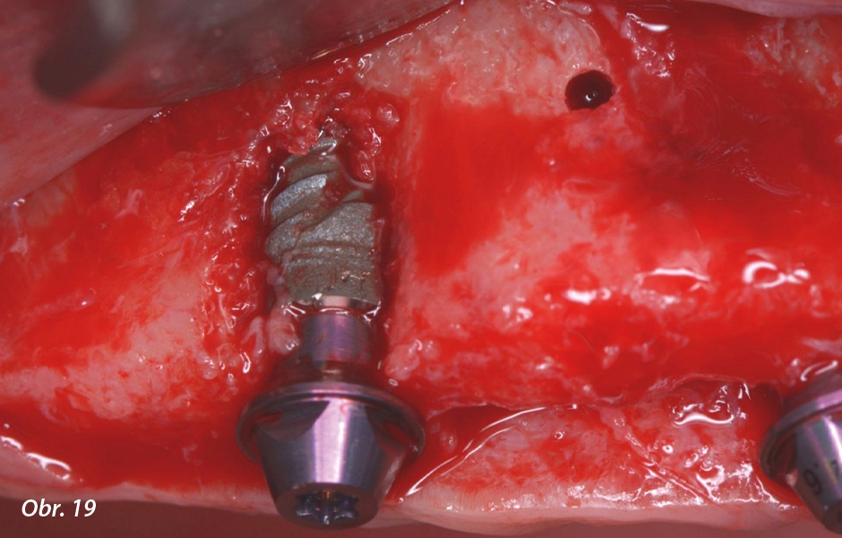 Celková rekonstrukce chrupu u bezzubého pacienta pomocí implantátů Straumann® BLX a konceptu Pro Arch navigovaná chirurgie