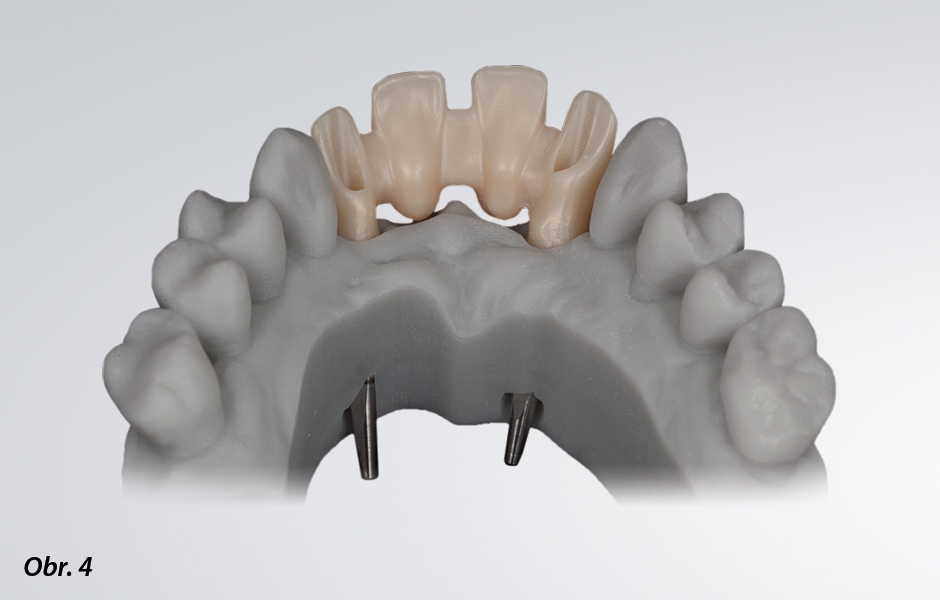 Různé příklady vytištěných pracovních modelů pro náhrady kotvené implantáty – před implantací lze také zhotovit model s přesnou pozicí implantátů