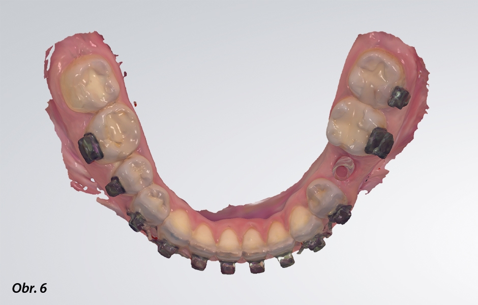 Příklad digitálního pracovního postupu: po získání dat z intraorálního skeneru se pomocí CAD vytvoří virtuální pracovní model i protetická konstrukce…