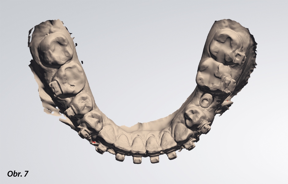 Příklad digitálního pracovního postupu: po získání dat z intraorálního skeneru se pomocí CAD vytvoří virtuální pracovní model i protetická konstrukce…