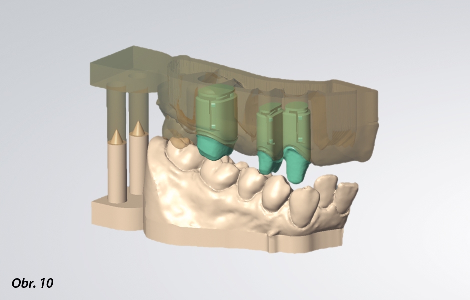 Speciální design pahýlu v CAD/CAM programu Cares Visual. Elastická vodicí křidélka vyrovnávají odchylku cca 30 µm k ose zubu. Tyto prvky zajišťují pahýly i při jejich rozdílné geometrii v přesné pozici.