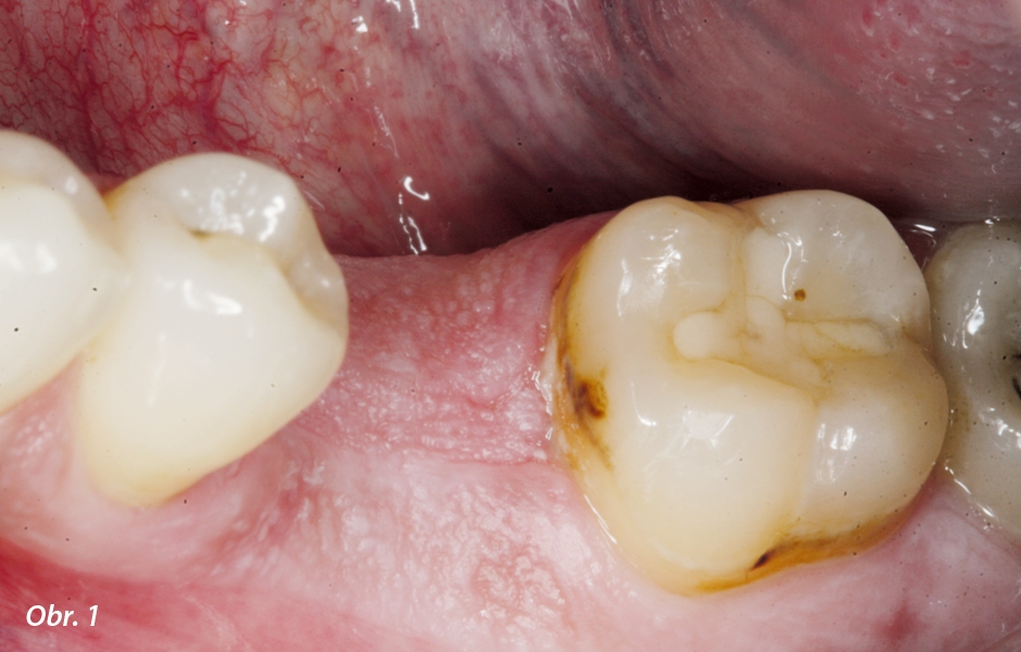 Počáteční klinická situace po zhojení extrakční rány v místě zubu 36: Kostní základna byla široká a v místě byl dostatek keratinizované gingivy.