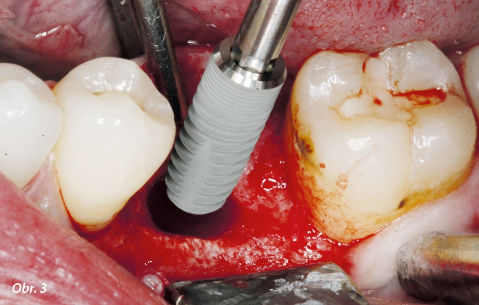 Po preparaci implantologickým motorem Implantmed byl stejným motorem našroubován implantát (průměr 4 mm, délka 12 mm) za točivého momentu 43 Ncm.