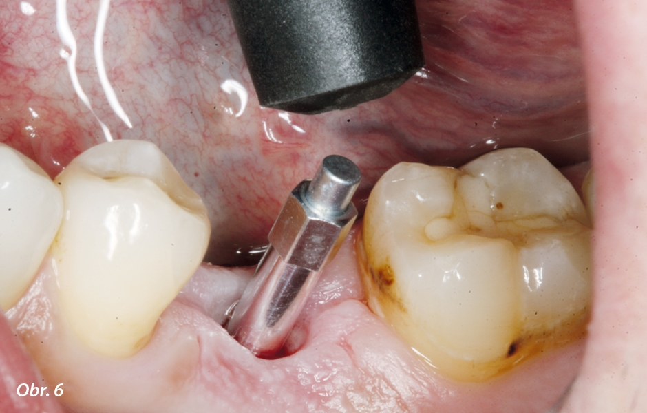 Za dalších deset týdnů bylo možno odstranit prvek na modelaci gingivy, který byl našroubován na implantátu. V lingvobukálním směru byla hodnota ISQ 63 prakticky nezměněna od původní (měřicí sonda byla ve vzdálenosti 2–3 mm).