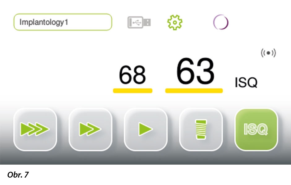 Zobrazení hodnoty ISQ na přístroji Implantmed – k měření ISQ není potřebné samostatné zařízení a naměřené hodnoty se ukládají spolu s dalšími údaji o preparaci lůžka pro implantát a z průběhu zavádění implantátu.