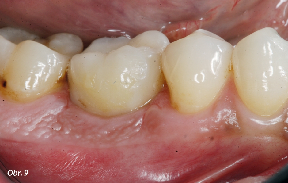 Definitivní kompozitní korunka byla v laboratoři nacementována na PEEK hybridní abutment a v ordinaci ji pak bylo možno rovnou našroubovat na implantát.