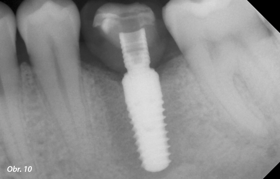 Kontrolní RTG snímek ukazuje úspěšnou oseointegraci implantátu a dosed šroubované korunky beze spáry.