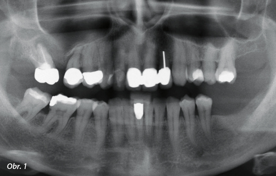 Ortopantomogram s atrofií kosti v oblasti zubů 16–14
