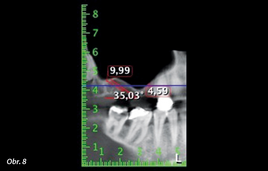 DVT s naplánovaným úhlem zavádění implantátu do oblasti zubu 16