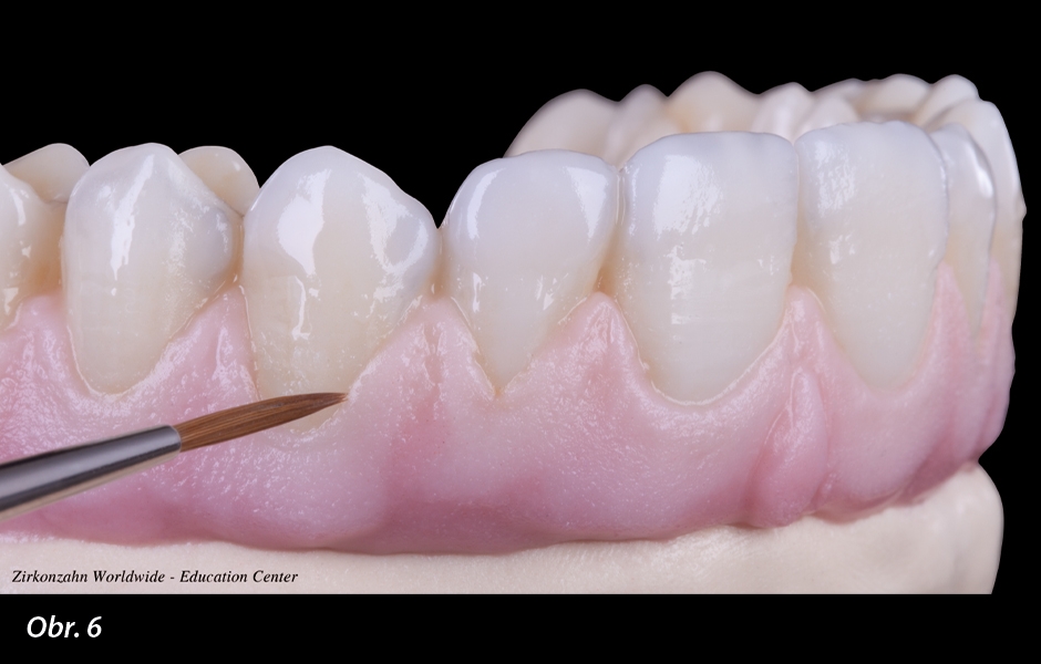 Nanášení roztoků Fresco Gingiva a Fresco Enamel na zuby a gingivu před vypalováním. Aby bylo možno aplikovat estetické vrstvení na vestibulární plošky zubů, byla provedena minimální redukce frontální oblasti zubů u horní čelisti.