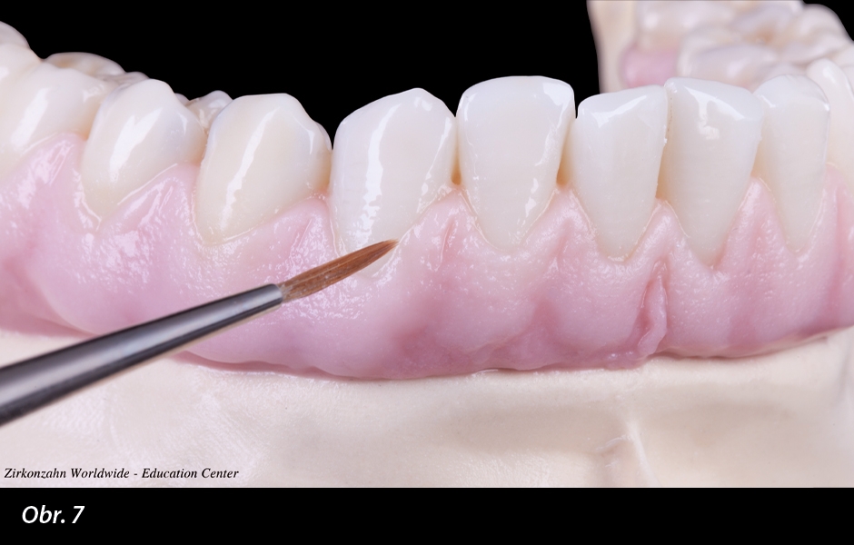 Nanášení roztoků Fresco Gingiva a Fresco Enamel na zuby a gingivu před vypalováním. Aby bylo možno aplikovat estetické vrstvení na vestibulární plošky zubů, byla provedena minimální redukce frontální oblasti zubů u horní čelisti.