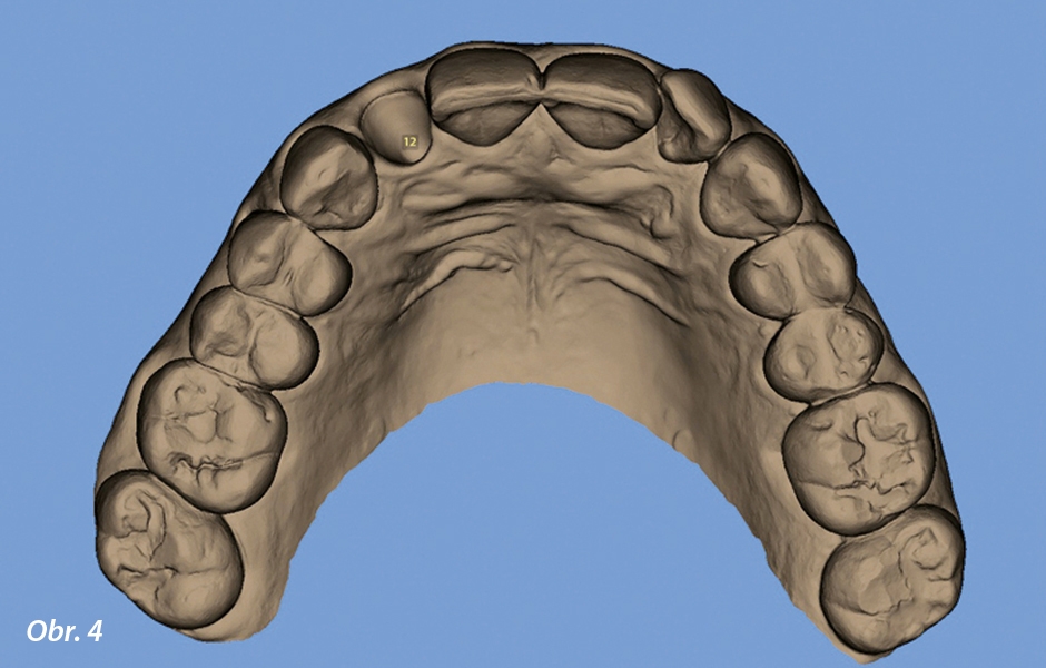 Virtuální extrakce zubu vyžadujícího ošetření