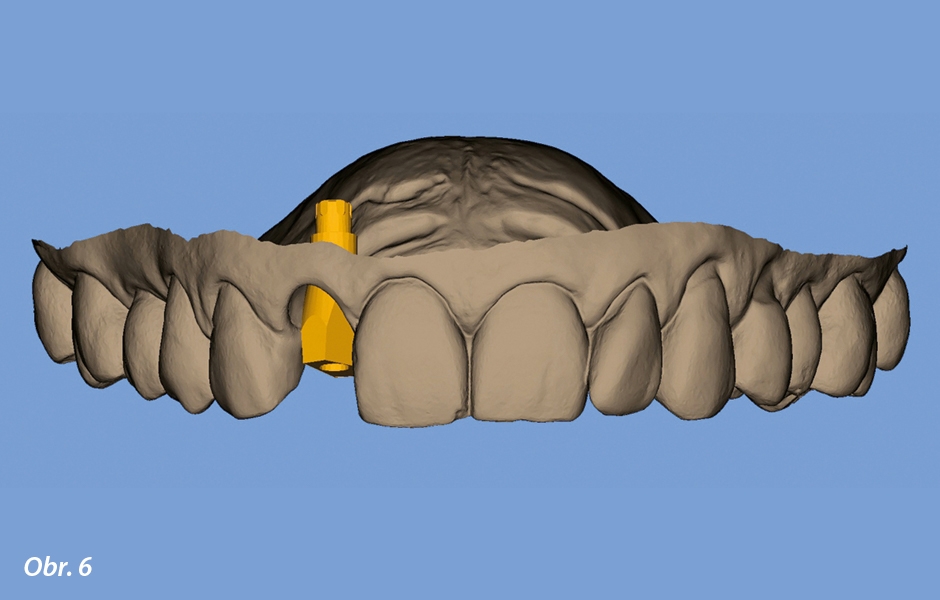 Digitálně navržená alveolární kavita se skenovacím tělískem implantátu