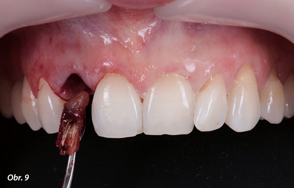 Atraumatická extrakce zubu.