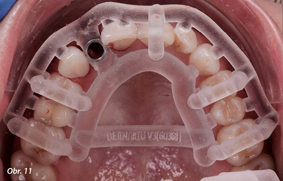 Chirurgická šablona a implantát po zavedení.