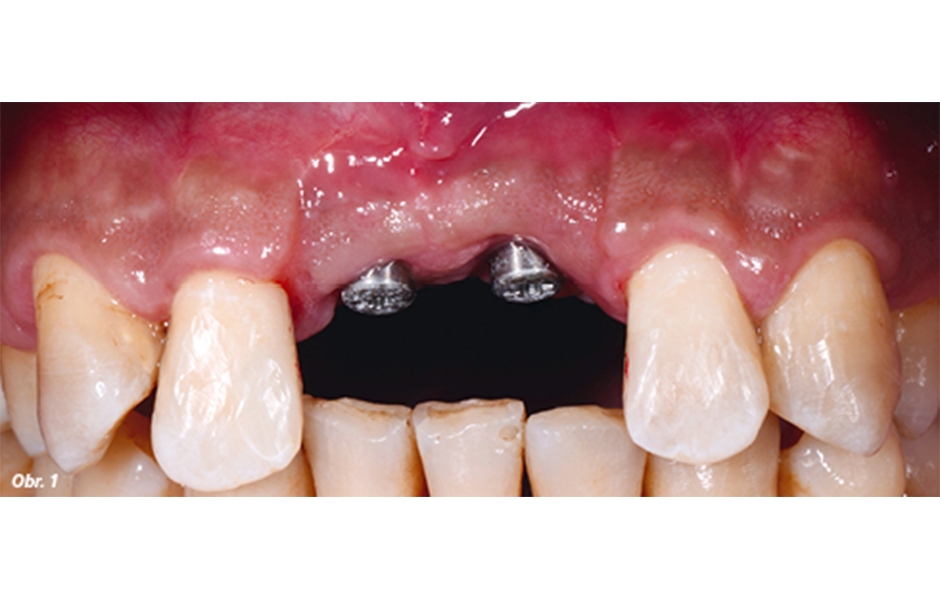 Situace po zavedení implantátů v oblasti zubu 11 a 21 po zhojení