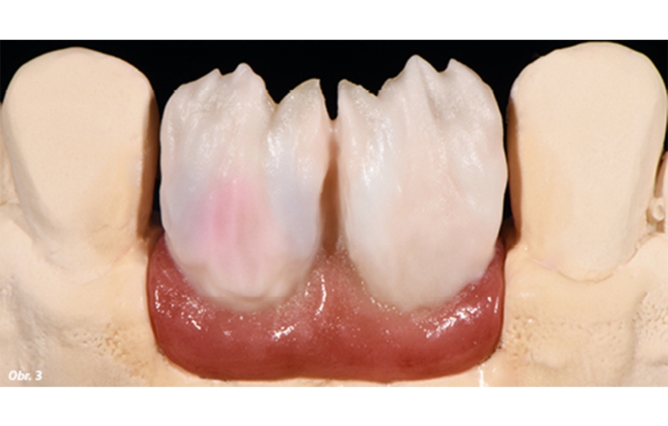 K napodobení dásní byl použit materiál IPS e.max ZirPress G4, základní opacita korunek byla definována materiálem IPS e.max Ceram Deep Dentin A3. Dále byly technikou postupného vrstvení naneseny materiály, IPS e.max Ceram Dentin A3.5, IPS e.max Ceram Powe