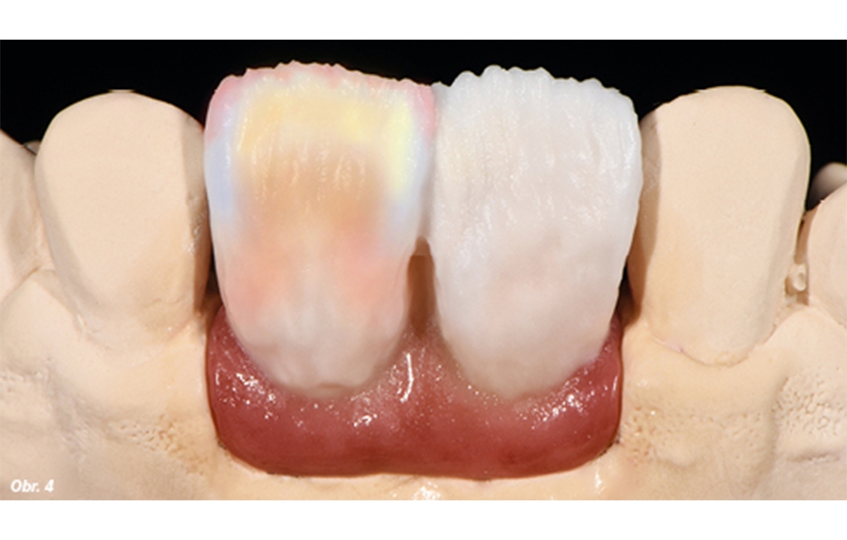 Dále byly za účelem imitace hloubky v krčkové oblasti zubu naneseny materiály IPS e.max Ceram Special Incisal šedý a Cervical Transpa oranžový, IPS e.max Ceram Selection Special Enamel quartz (SEqu) a IPS e.max Ceram Opal 2 (OE2). K individualizaci incizn